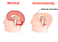 Anencephaly Lawsuit