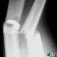 Avandia Actos Bone Fracture