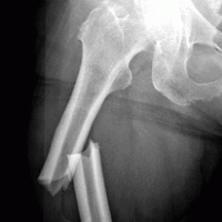 Bisphosphonate Bone Fracture Lawsuit