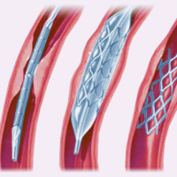 Blood Vessel Angioplasty NSF Lawyers
