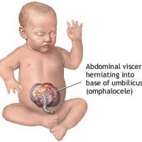 Omphalocele
