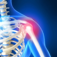 Pain Pump Lawsuit