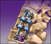 Spinal-Device-Recall-Lawyers