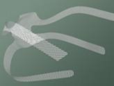 Transvaginal Mesh Lawsuit