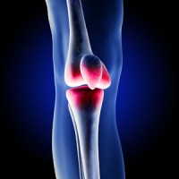 Zimmer-Nexgen-Knee-Lawsuit
