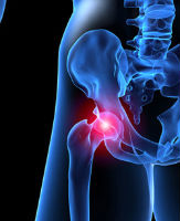 depuy hip lawsuit