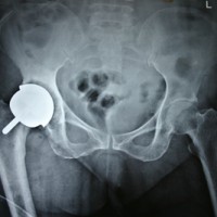 Zimmer Durom Hip Cup Lawsuit