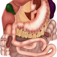 gastric-bypass-surgery-bariatric-surgery