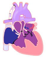 heart birth defect antidepressant drug injury ssri lawyer lawsuit attorney class action litigation settlement claim