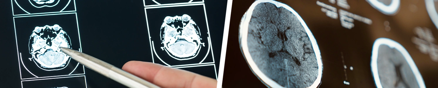 A brain MRI scan collage 