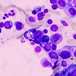 A Waldenström Macroglobulinemia under the microscope