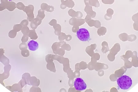 Chronic Lymphocytic Leukemia under the microscope
