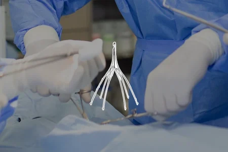 Argon IVC Filter and some surgeons in the background