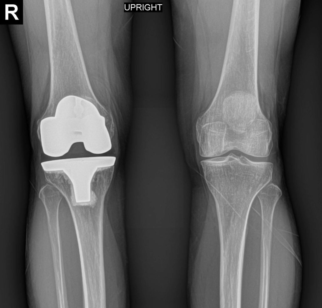 Exactech Knee Lawsuit Knee Replacement Lawyer