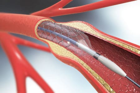 Jet 7 Catheter Lawsuit