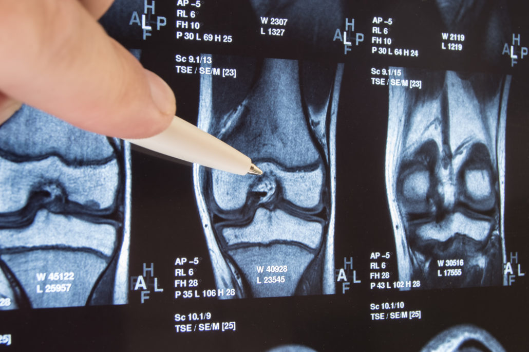 Knee Replacement Revision Surgery Lawsuit Knee Surgery Lawyer