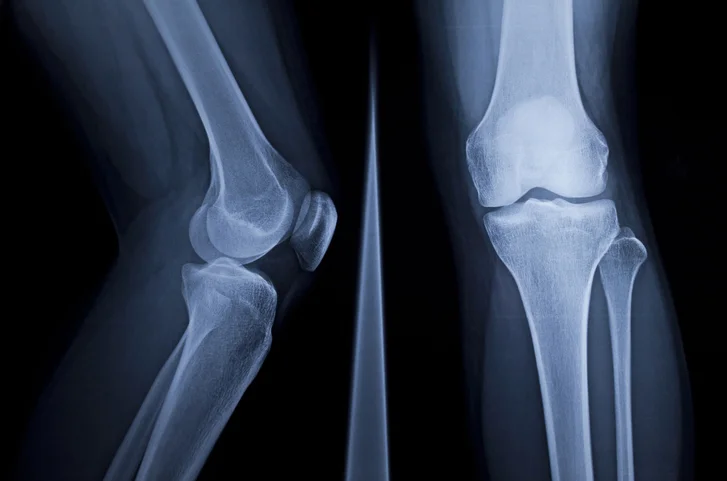 Lawsuits Knee Replacement