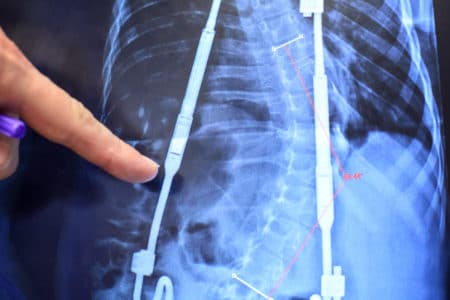 Magec Rod Scoliosis Surgery