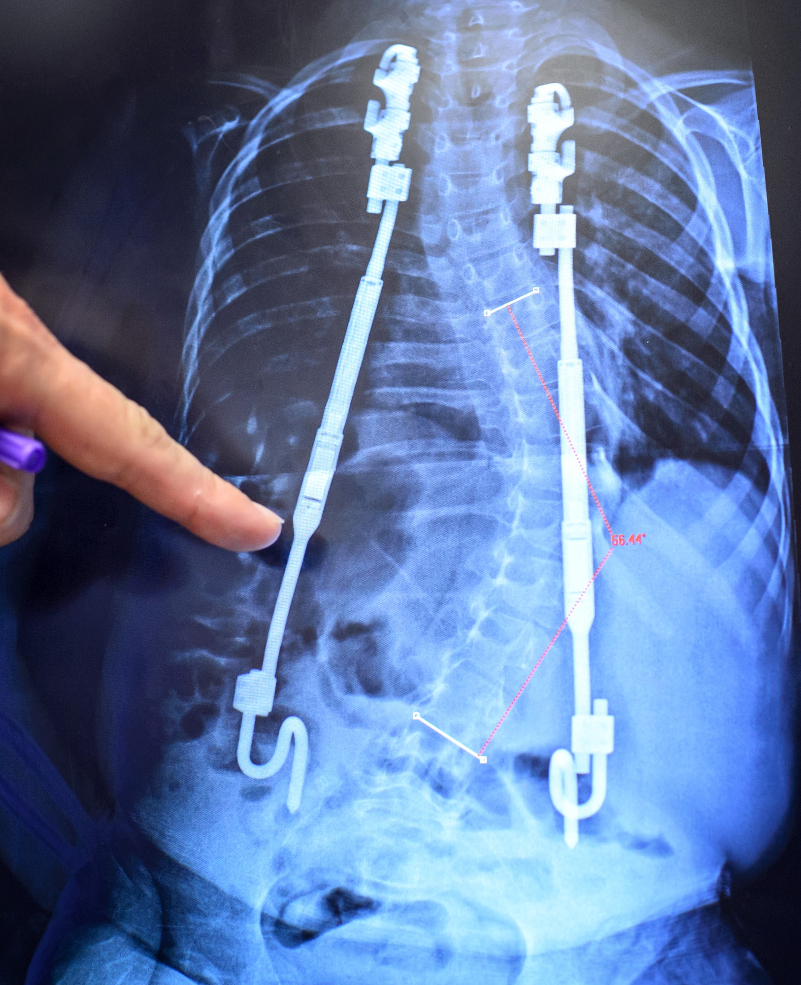 Magec Rods Lawsuit in 2024 (Get Free Case Review Today)