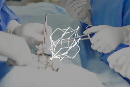 Surgeons in an operation placing OptEase IVC filter