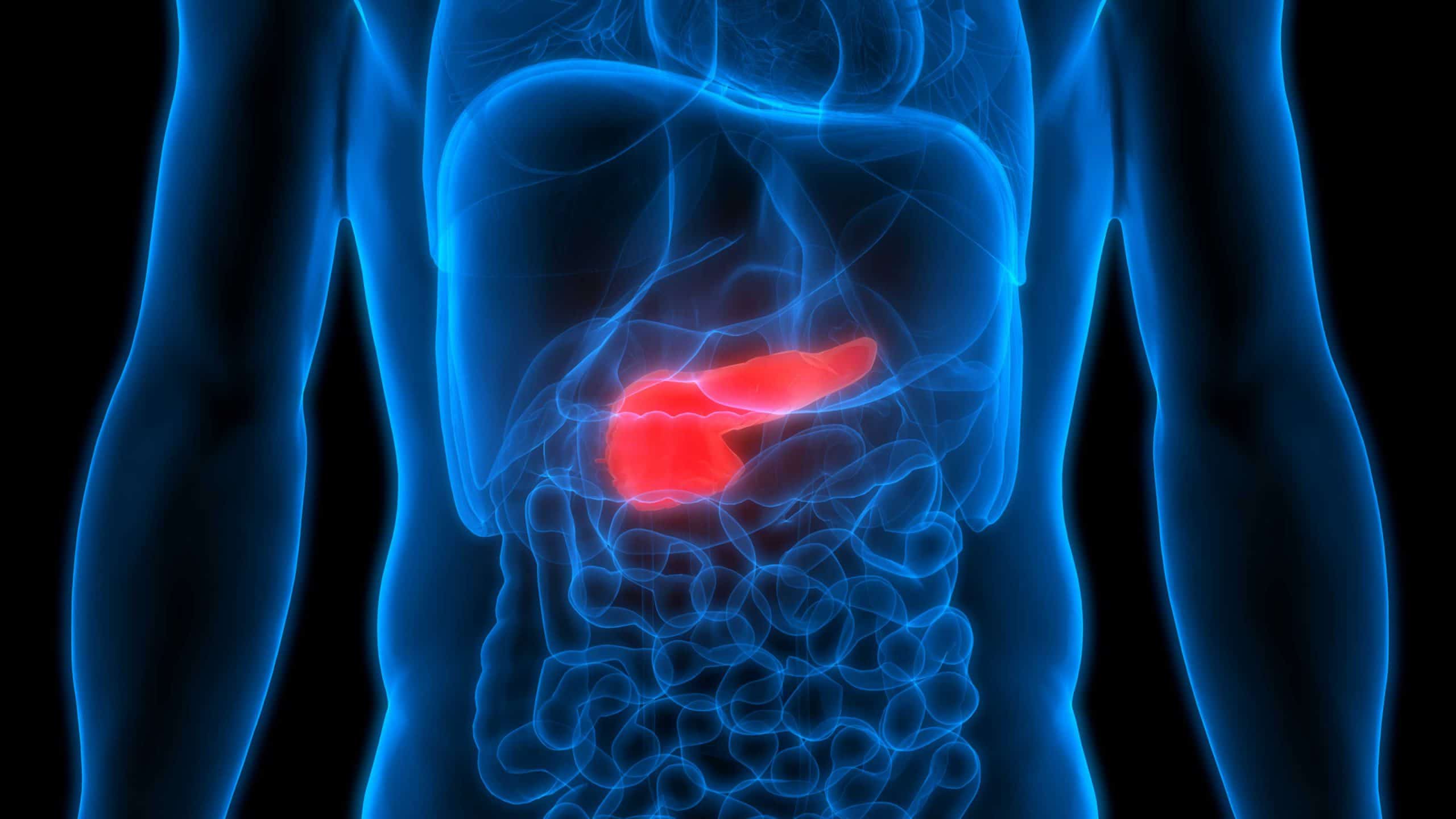 Pancreatitis and Pancreatic Cancer