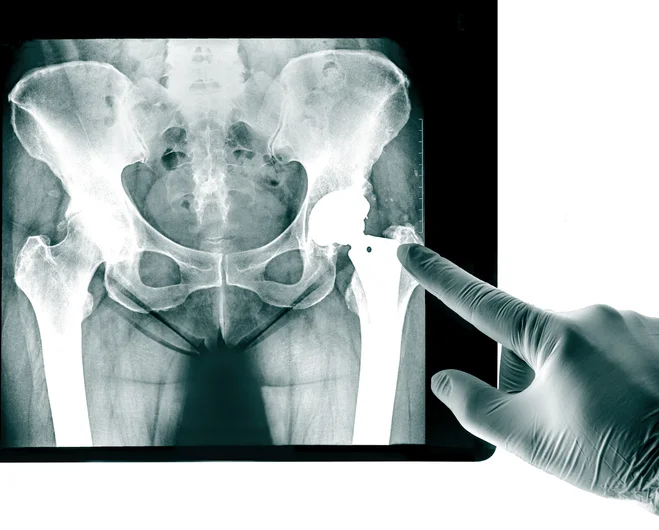 Settle Hip Replacement MDL