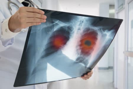 Silicosis Lawsuit