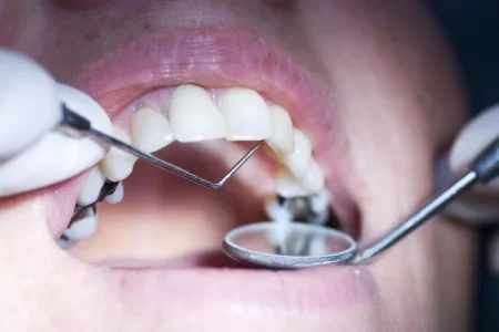 Suboxone Tooth Decay Lawsuit