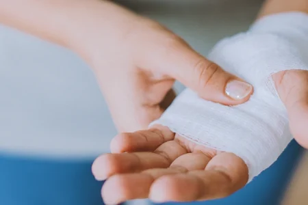 A person with a tanning bed burn injury on her hand