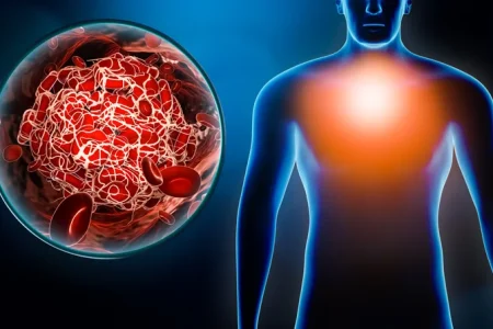 The Link Between Xeljanz and Pulmonary Embolism