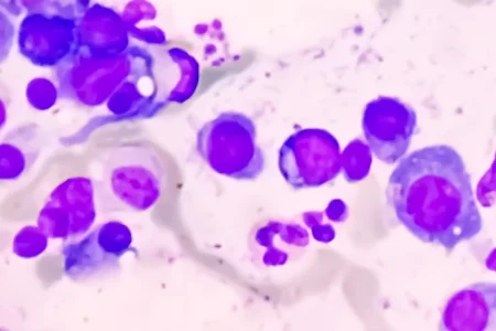 A microscopic image of Waldenström Macroglobulinemia