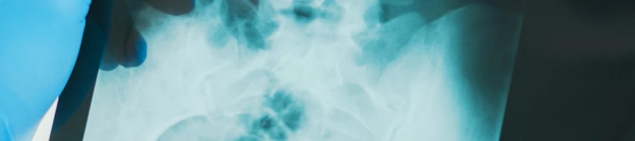 Implant migration x-ray