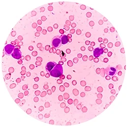 Leukemia cells under the microscope