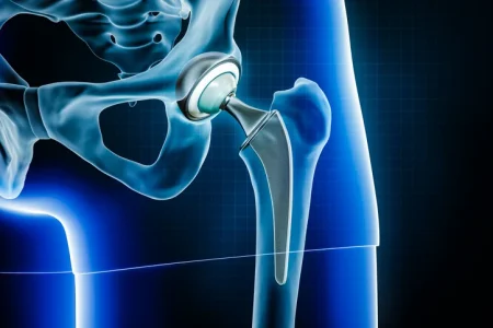 Zimmer Hip & Knee Implants Lawsuit