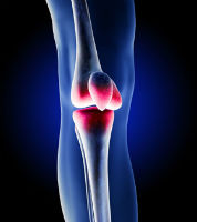 Zimmer Knee replacement Lawsuit