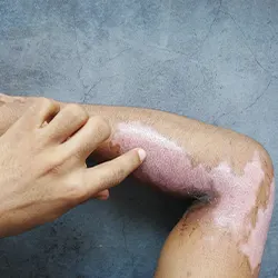 arm with burn injuries