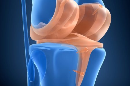 Knee Implant
