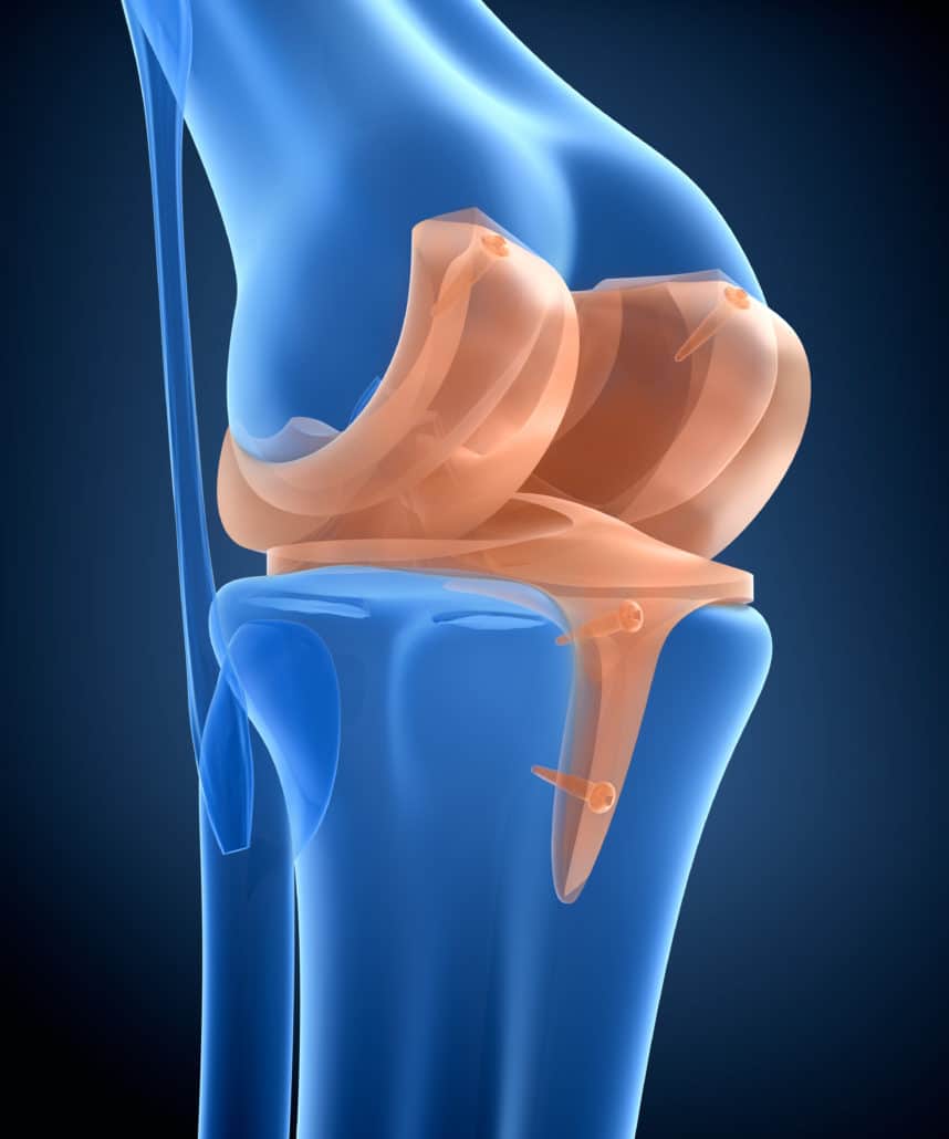 Arthrex Knee Lawsuit Knee Replacement Lawyer