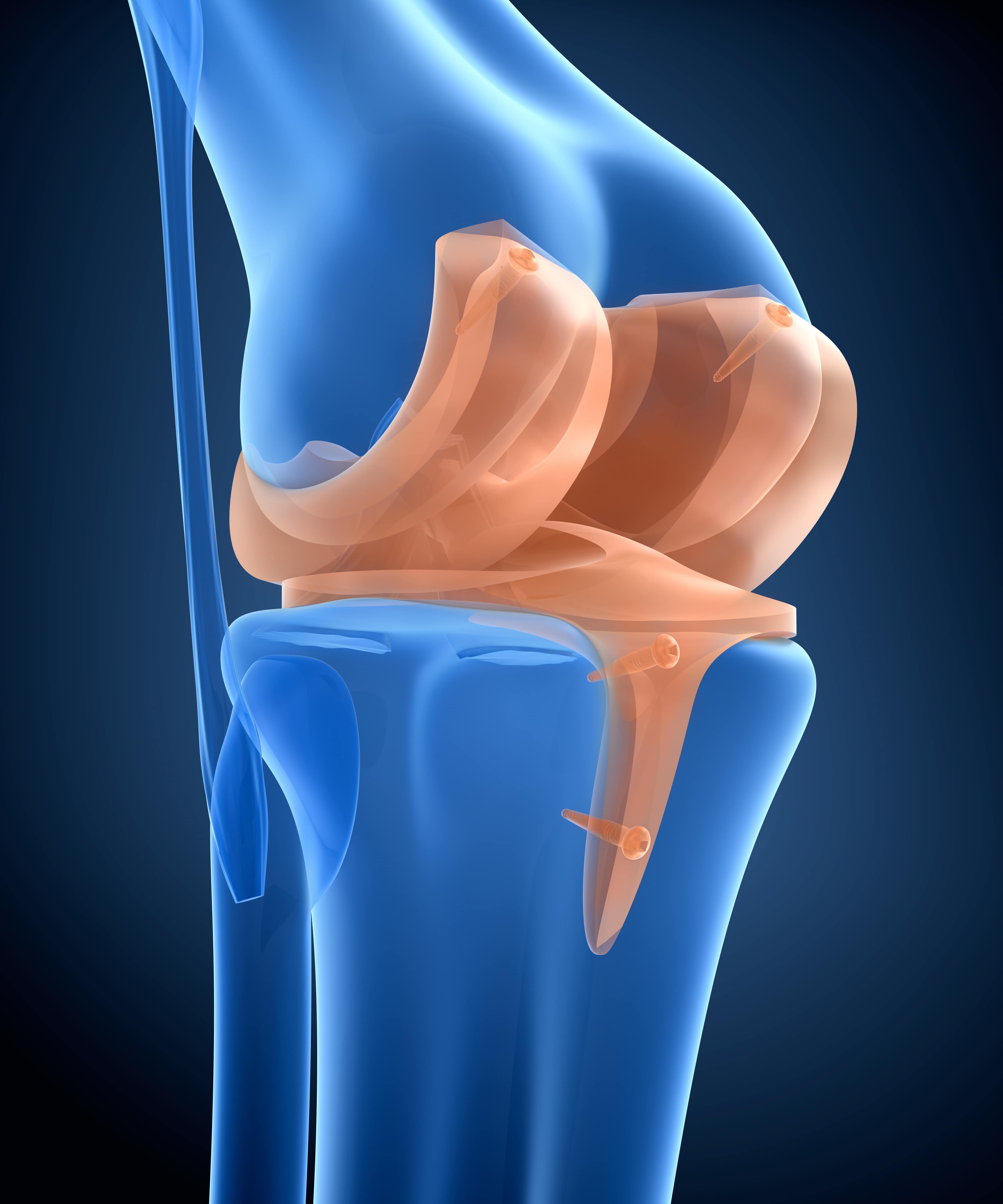 DePuy Synthes Attune Knee Lawsuit Knee Replacement Lawyer DePuy Synthes Attune Knee Lawsuit Knee Replacement Lawyer