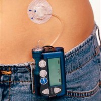 Insulet Insulin Pump Lawsuit