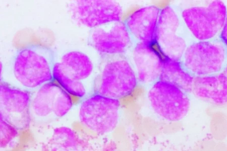 A large granular Lymphocytic Leukemia under the microscope